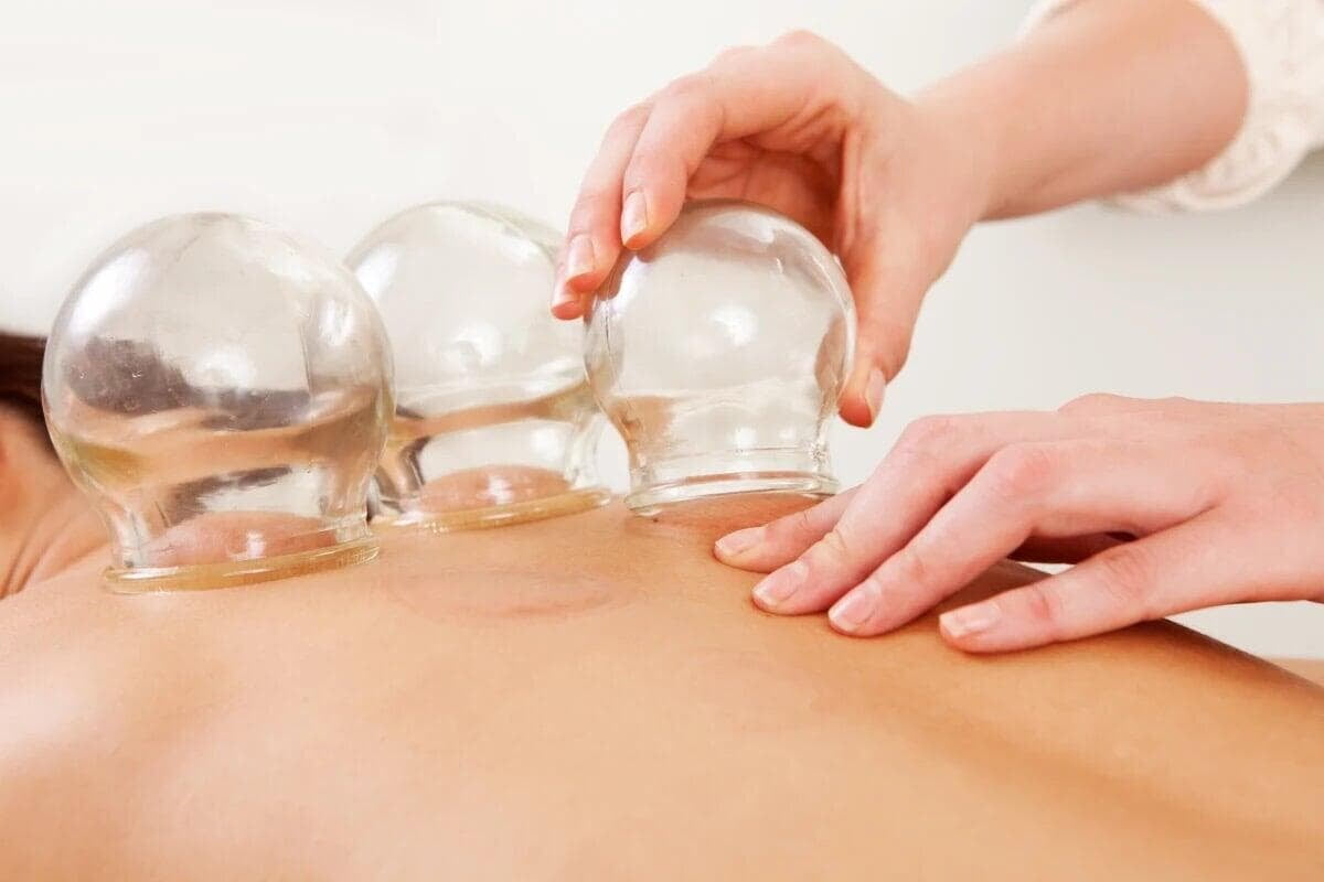 Cupping image, halifax healing, therapy